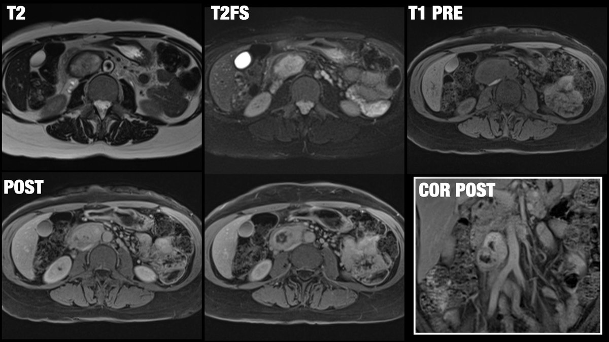 56-year-old female patient presenting with heterogeneous retroperitoneal mass... can you guess the diagnosis? 

<a href="/BrighamRad/">Brigham and Women's Radiology</a> <a href="/FOAMrad/">FOAMrad</a> <a href="/SAR_RFS/">SAR Resident and Fellow Section</a> <a href="/futureradres/">Future Radiology Residents</a> <a href="/ARRS_Radiology/">ARRS</a> <a href="/Abdominal_Rad/">Abdominal Radiology</a> <a href="/CBRadiologia/">CBR</a> #MedEd