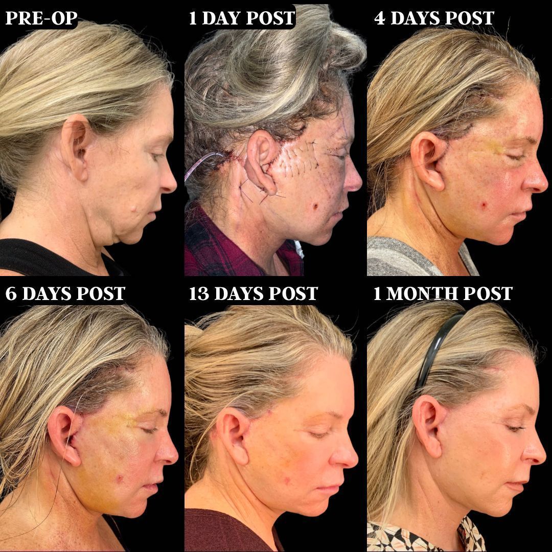 RobbJrMD's tweet image. Traci's healing after ROBB REFRESH💯

Traci had a bad experience with a previous face &amp;amp; neck lift at a different practice that left her feeling hopeless👎🏻

Her pre-op photo above is 1 year after that prior surgery elsewhere.

1 month later, her results are 🤌🏼