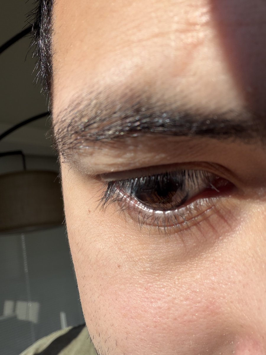 joeyigw's tweet image. Look at my eyeball today