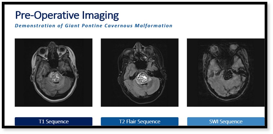 StevenBremMD's tweet image. 3/8 🧵The key takeaways are: 

1. Two patients, one presenting with a lesion in the #pons, the other  an intramedullary #spinalcord malformation present unique surgical challenges

2. The management &amp;amp; indications for intervention  are reviewed with specific illustrations of key…