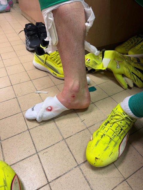 ActuFoot_'s tweet image. 🦵🩸 LA CHEVILLE DE LUCAS CHEVALIER 🇫🇷 À LA MI-TEMPS APRÈS LA GROSSE SEMELLE DE CAMARA 🇸🇳 !

📸 @ArthurPerrot @RMCsport