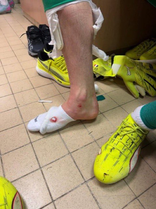 🤯🩸La cheville de Lucas Chevalier à la mi-temps contre Monaco 🇲🇨

Plus de peur que de mal 😳

(📸: <a href="/ArthurPerrot/">Arthur Perrot</a> / <a href="/RMCsport/">RMC Sport</a>) 

#ASMPSG | #Ligue1