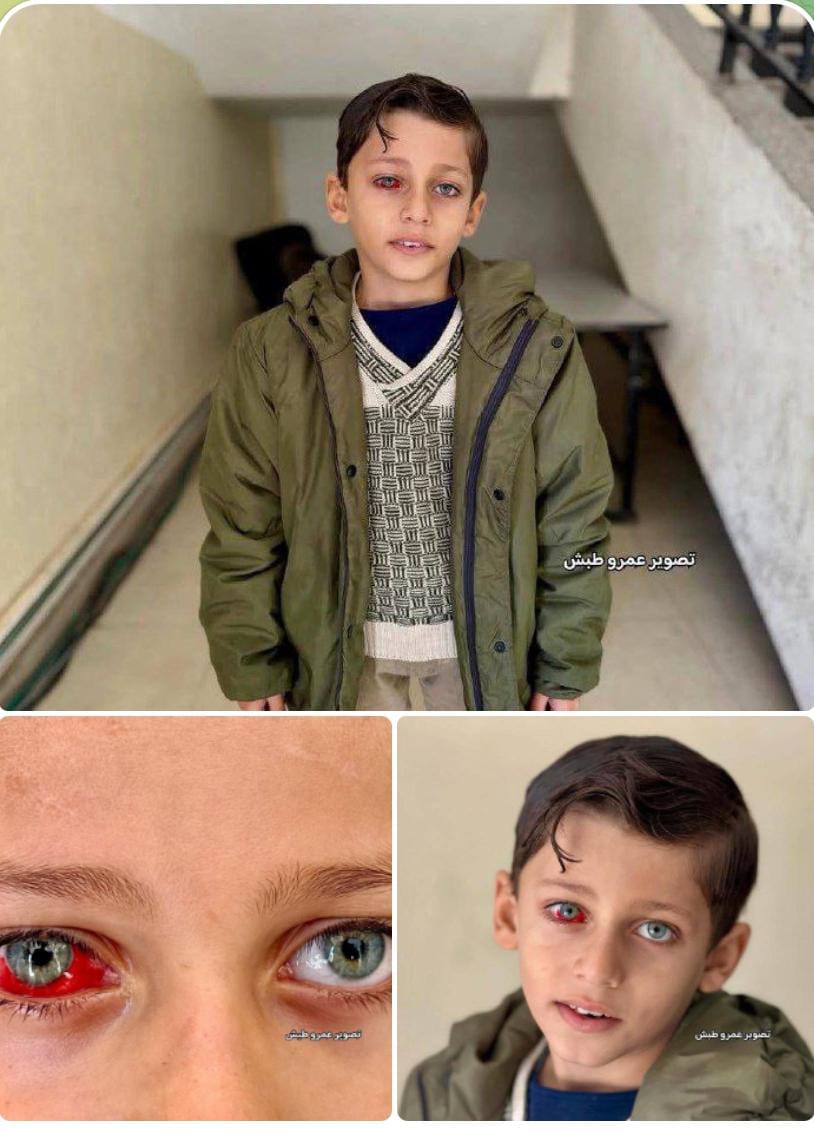 Gazzeli Ali Ebu Sobha.
Ali, 8 yaşında.
İşgalci israilli teröristlerin Gazze'ye düzenlediği hava saldırı sonrası çadırda kalan ailesine temiz su almaya giderken enkaz üzerinde yüksekten düştü.

Sol gözünde görme yetisini kaybetmek üzere.

Sağlık ekipleri, Ali'nin durumunun