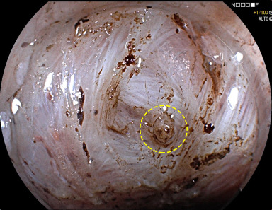 iGIEjournal's tweet image. In BRIEF COMMUNICATIONS: iMAGES in iGIE, Yang et al characterize &quot;The role of magnifying endoscopy in detecting vessels after gastric endoscopic submucosal dissection.&quot; igiejournal.org/article/S2949-…

#GITwitter 

@gutdoc18
