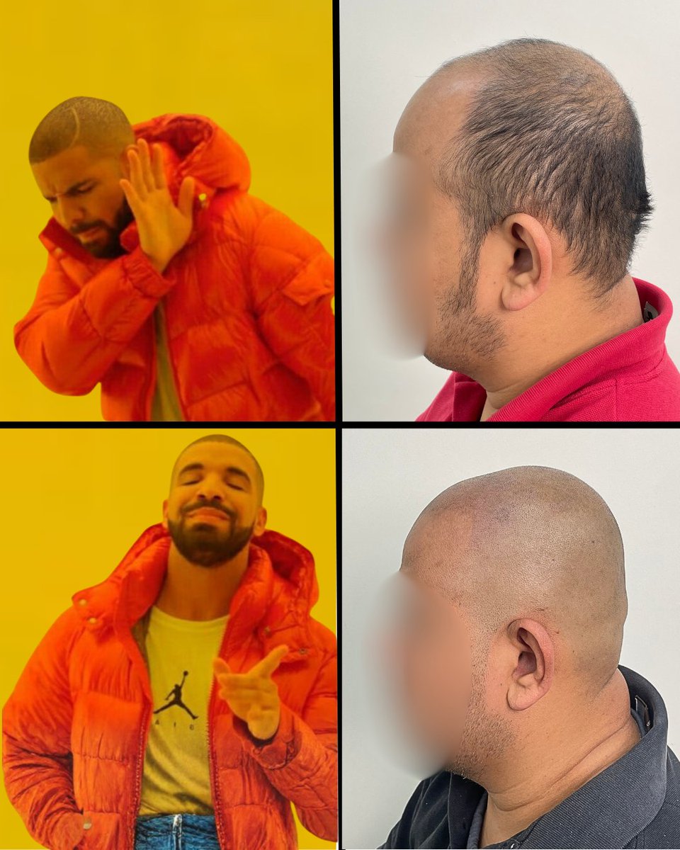 onurakdenizsmp's tweet image. 🔥 Balding that stresses you out? Nope.
A sharp, clean SMP result? Absolutely yes.

#smp #micropigmentation #meme #hairlossmeme #smpmeme