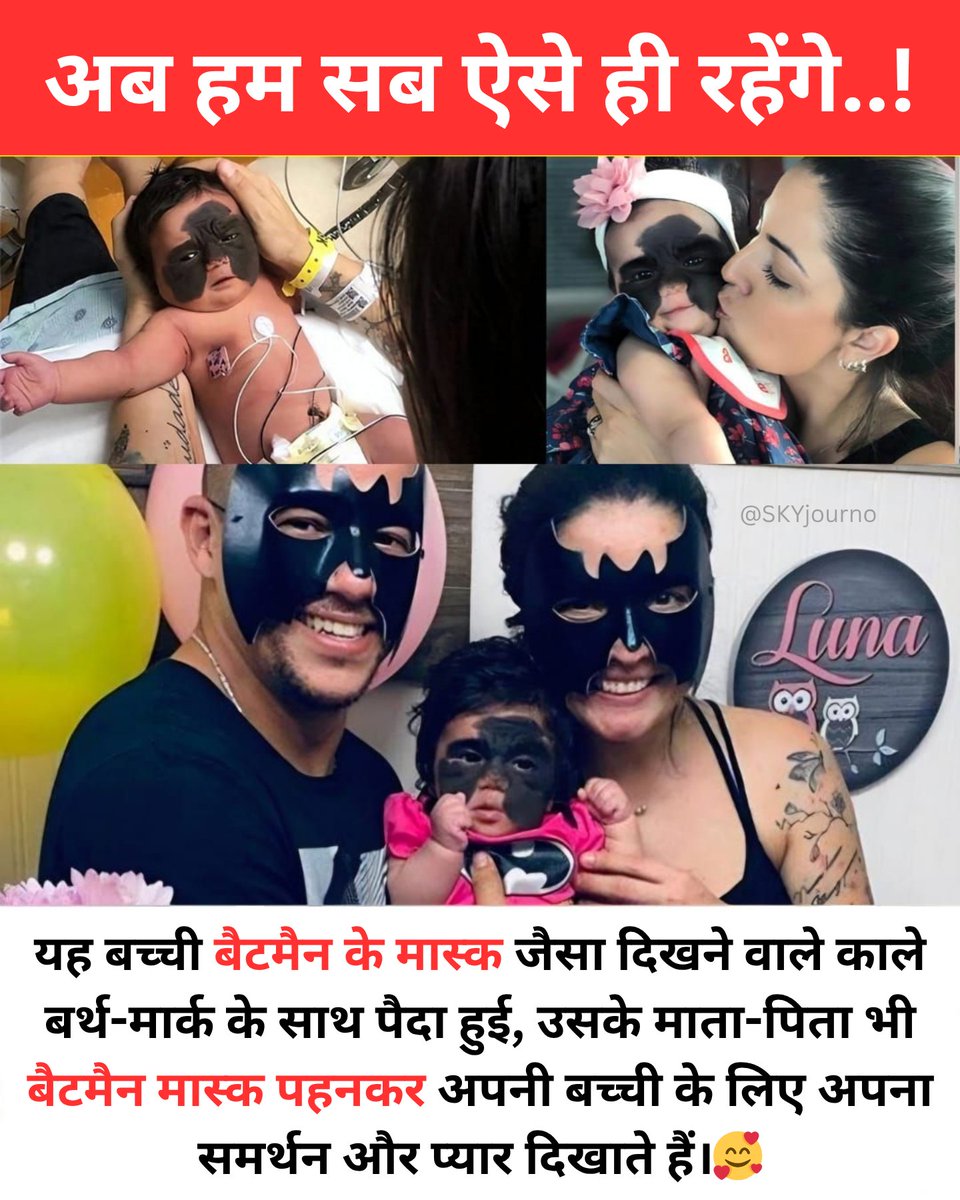 ये कहानी किसी फिल्म का सीन नहीं… बल्कि असल ज़िंदगी का चमत्कार है..!

एक नन्ही-सी बच्ची, जो जन्म लेते ही अपने चेहरे पर एक बड़ा काला जन्म-चिह्न लेकर आई - कुछ ऐसा जैसे बैटमैन का मास्क। पहली नज़र में कुछ लोग देखकर चौंक जाते… कोई डरकर पीछे हटता, तो कोई सवाल पूछता।

लेकिन उसके