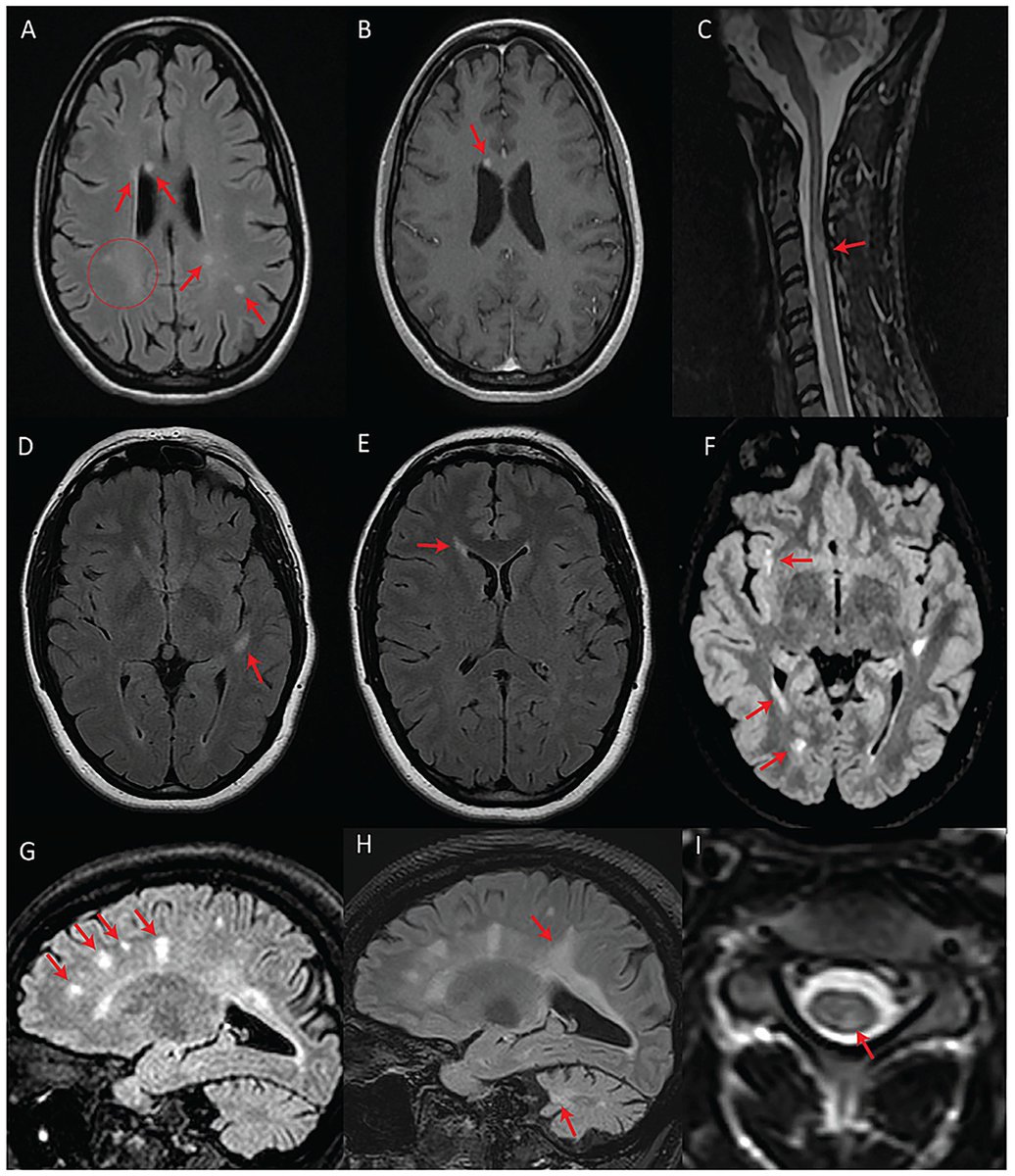 Are these MRI findings in people with multiple sclerosis?  Shockingly, NO!  They actually have Wolfram syndrome (WFS), a rare genetic disorder associated with pathogenic variants in WFS1 and is linked to optic atrophy, hearing loss and diabetes. frontiersin.org/journals/neuro…