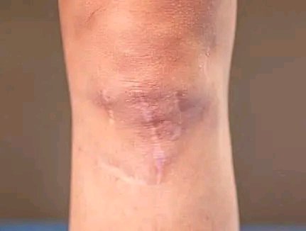 bongeezy_'s tweet photo. If you don't have one of these on your legs, your childhood wasn't fun https://t.co/AzcwA0m6MD
