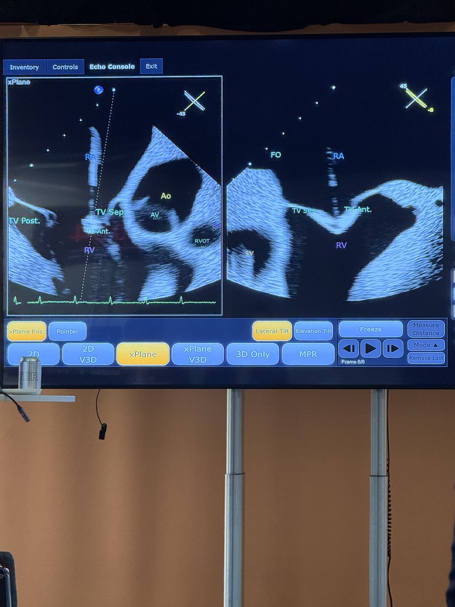 BenekiEirini's tweet image. #PCRLV 

Good morning ☀️ 

Happening now at Imaging Learning Lab!

#ICE for #tricuspid valve interventions 

@nicolo_piazza 

@PCRonline @PamelaGatto @DrGarot @drtsakamoto @dr_chrisallen @juliendreyfus1 @alcantaramonica @MiChen__ @CurioJonathan @TagliariPaula @jcecharte