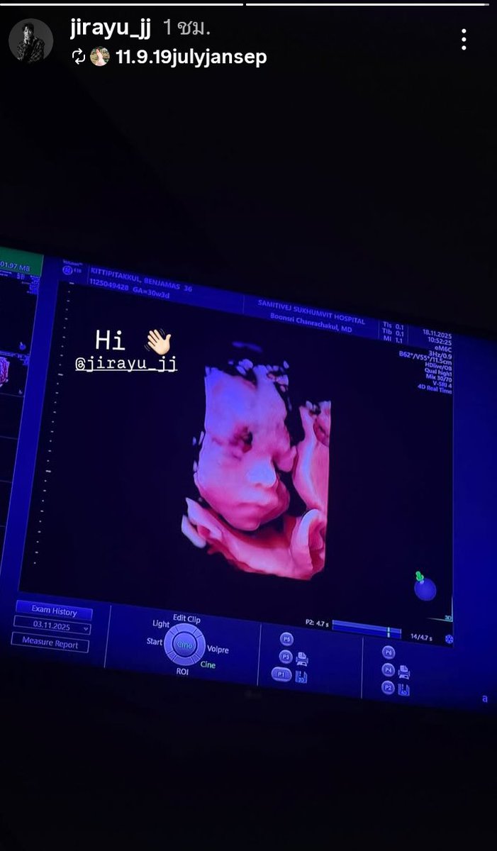 น้องพบรัก(ขอเดาว่าชื่อนี้)จมูกโด่งได้พ่อเจมส์มากเลยลูก