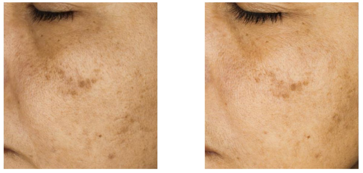#OpenAccess #Article

📑Title: Multifunctional, Novel Formulation for Repairing #Photoaged and #Sun-Damaged #Skin: Insights from In Vitro, Ex Vivo, and In Vivo Studies 

Authors: María Moneo-Sánchez et al.

📌 brnw.ch/21wXAjH