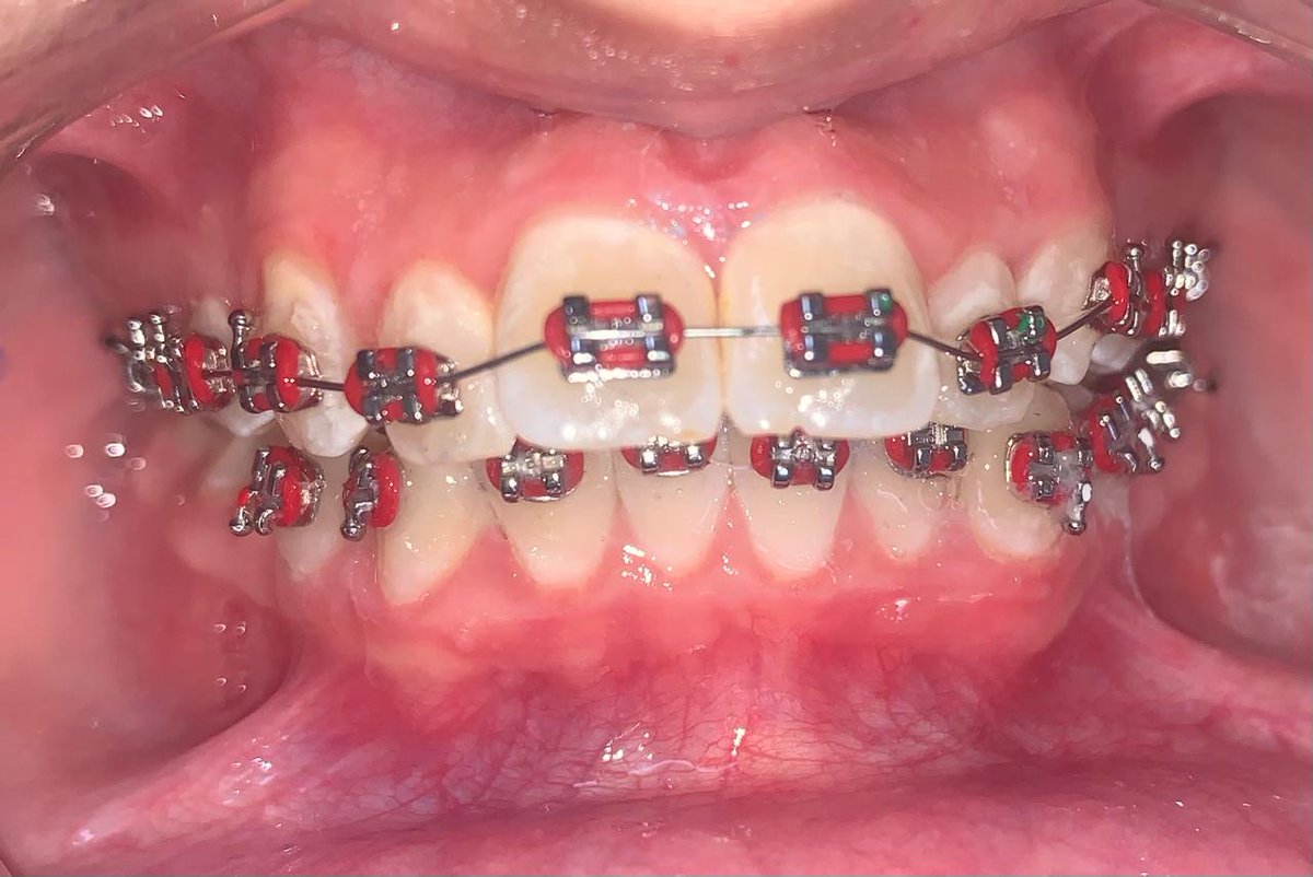 دكتور تقويم أسنان tweet media