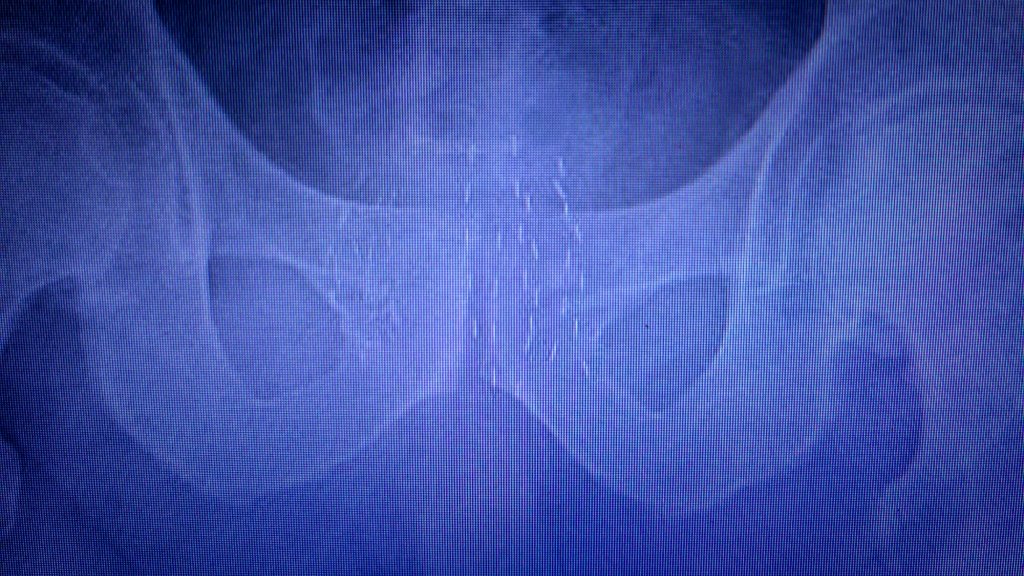 El 24 de octubre he realizado una nueva braquiterapia LDR por adenocarcinoma de próstata, esta vez en el lóbulo izquierdo, en un paciente ya tratado hace 13 años en el derecho con la misma técnica.

Repetir LDR en este contexto y con intención curativa es posible.