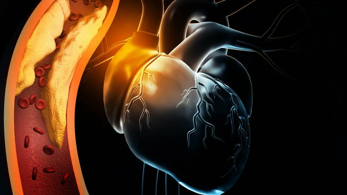 CuidatePlus's tweet image. Estas son las posibilidades de tener un infarto si no sigues tu tratamiento para el colesterol cuidateplus.marca.com/bienestar/2025…