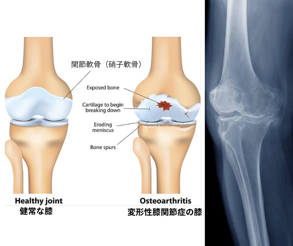 Dr_Postures's tweet image. 図を見て下さい。軟骨に神経はありません。

ここが膝痛を理解するうえで最も重要なポイントです。
レントゲンで軟骨がすり減っていても、軟骨そのものは痛みを感じません。
では、なぜ変形性膝関節症は痛むのか？…