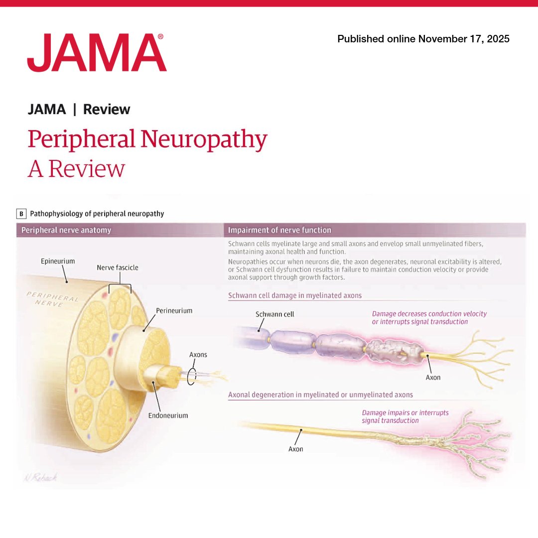 From <a href="/JAMA_current/">JAMA</a>: Peripheral neuropathy, defined as damage to the peripheral nerves, affects approximately 1% of adults worldwide. 

This Review summarizes the clinical presentation, diagnosis, and treatment of length-dependent peripheral neuropathy. 

ja.ma/43yY5ZX