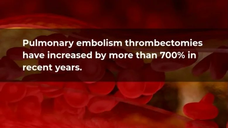 HemostasisToday's tweet photo. Thrombectomy Rates Rise 700% Nationwide
@StopTheClot
https://t.co/7II31CvmZA
#BloodClots #Health #HemostasisToday #Medicine #NationalBloodClotAlliance #NationalStudy #PE #PulmonaryEmbolism #Thrombectomy #MedEd #MedX https://t.co/0cPCpxHR7f
