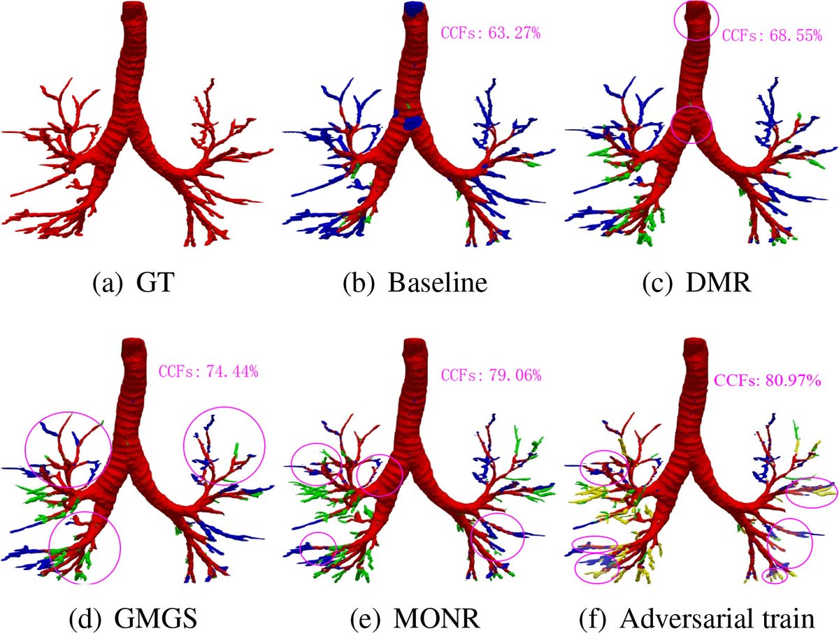 gyangMedIA's tweet image. Introducing DMGSA — a hybrid supervised–unsupervised framework for robust #airway #segmentation in #CT 🎯✨

Tested on lung cancer, COVID-19, and fibrosis datasets — DMGSA beats SOTA by a wide margin 🚀📊

lnkd.in/e269xiNs

#MedicalImaging #DeepLearning #MedicalAI #CTAI