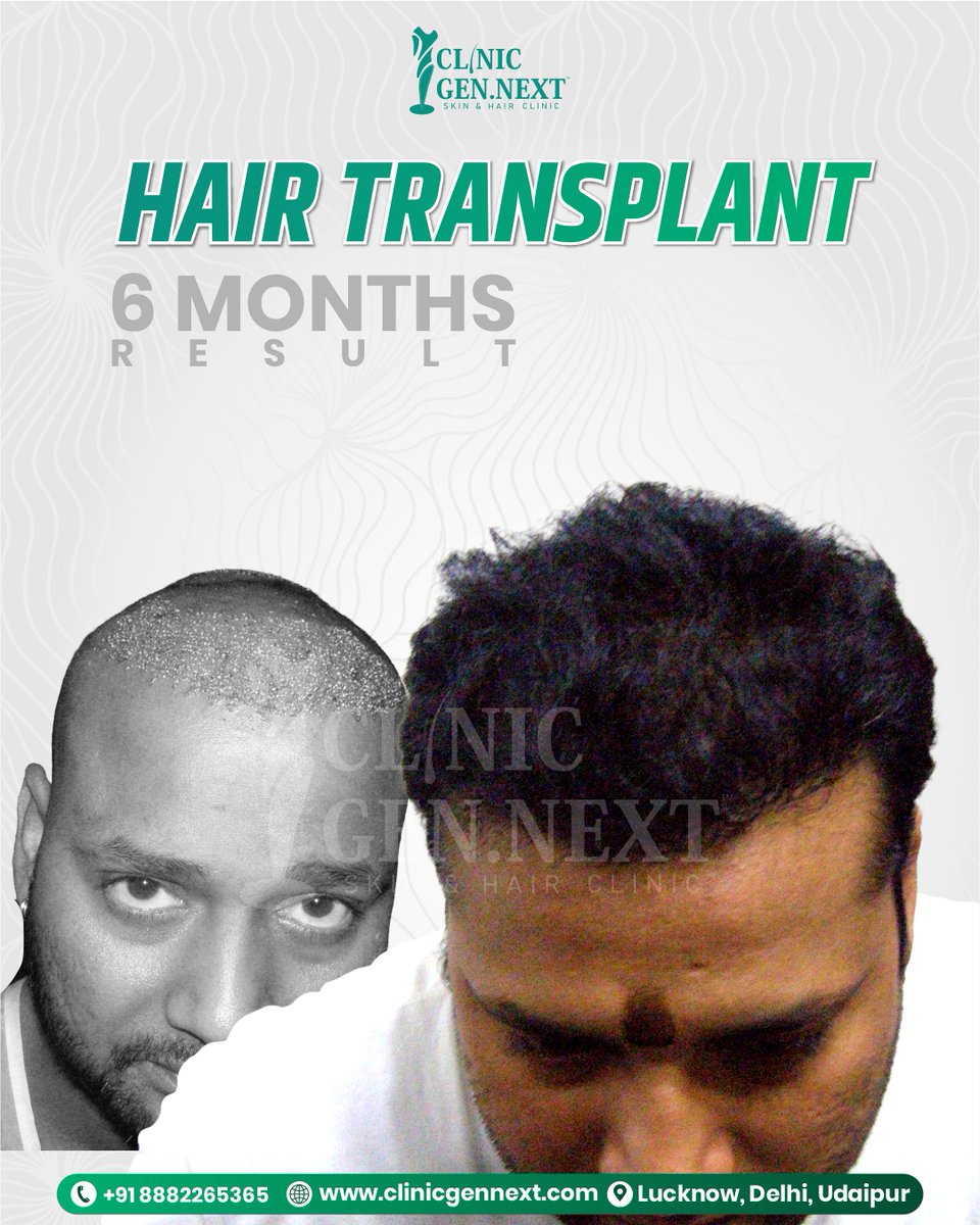 clinicgennext's tweet image. Witness the transformation! ✨
A powerful 6-month Hair Transplant result at ClinicGenNext—dense growth, natural hairline, and unmatched confidence.e | 📸 Instagram | 👍 Facebook | 🐦 Twitter
#DrKunal #DrKunalSingh #ClinicGenNext #BestHairTransplantClinicInIndia #HairTransplantDel