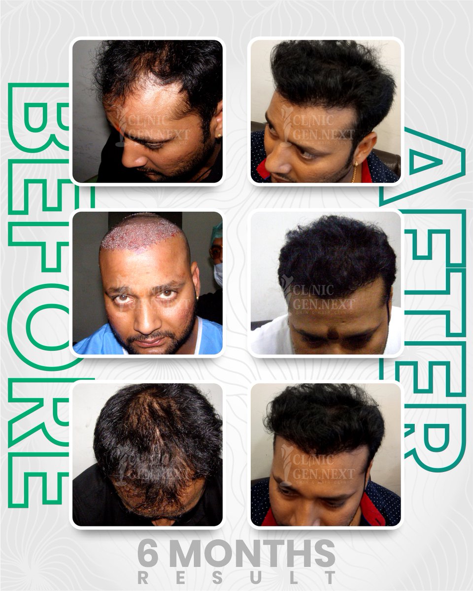 clinicgennext's tweet image. Witness the transformation! ✨
A powerful 6-month Hair Transplant result at ClinicGenNext—dense growth, natural hairline, and unmatched confidence.e | 📸 Instagram | 👍 Facebook | 🐦 Twitter
#DrKunal #DrKunalSingh #ClinicGenNext #BestHairTransplantClinicInIndia #HairTransplantDel