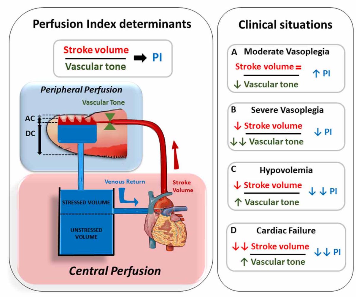 Single-center RCT finds benefit from sepsis resus that targets perfusion index (Pi)

Intervention group: fix macrohemodynamics, then target Pi &gt;1.4

Many limitations, but I think they're correct

Pi is similar to cap refill, but continuously displayed number on monitor 😍