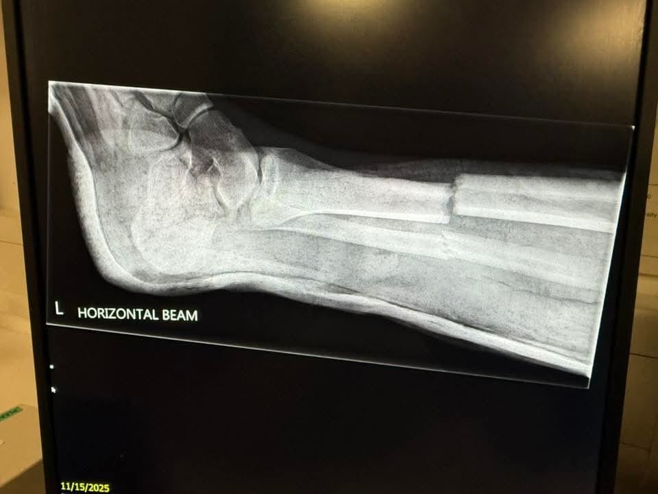 swpleague's tweet image. Below x-ray of the Ilfracombe player from abandoned game at Bridport 

@ilfcombeafc are campaigning to ban Micro Shin pads and
@BudeFc &amp;amp; @DobwallsFC have said signed up

SWP have written to @FA (awaiting reply) in meantime clubs asked to review policies regarding micro shin pads