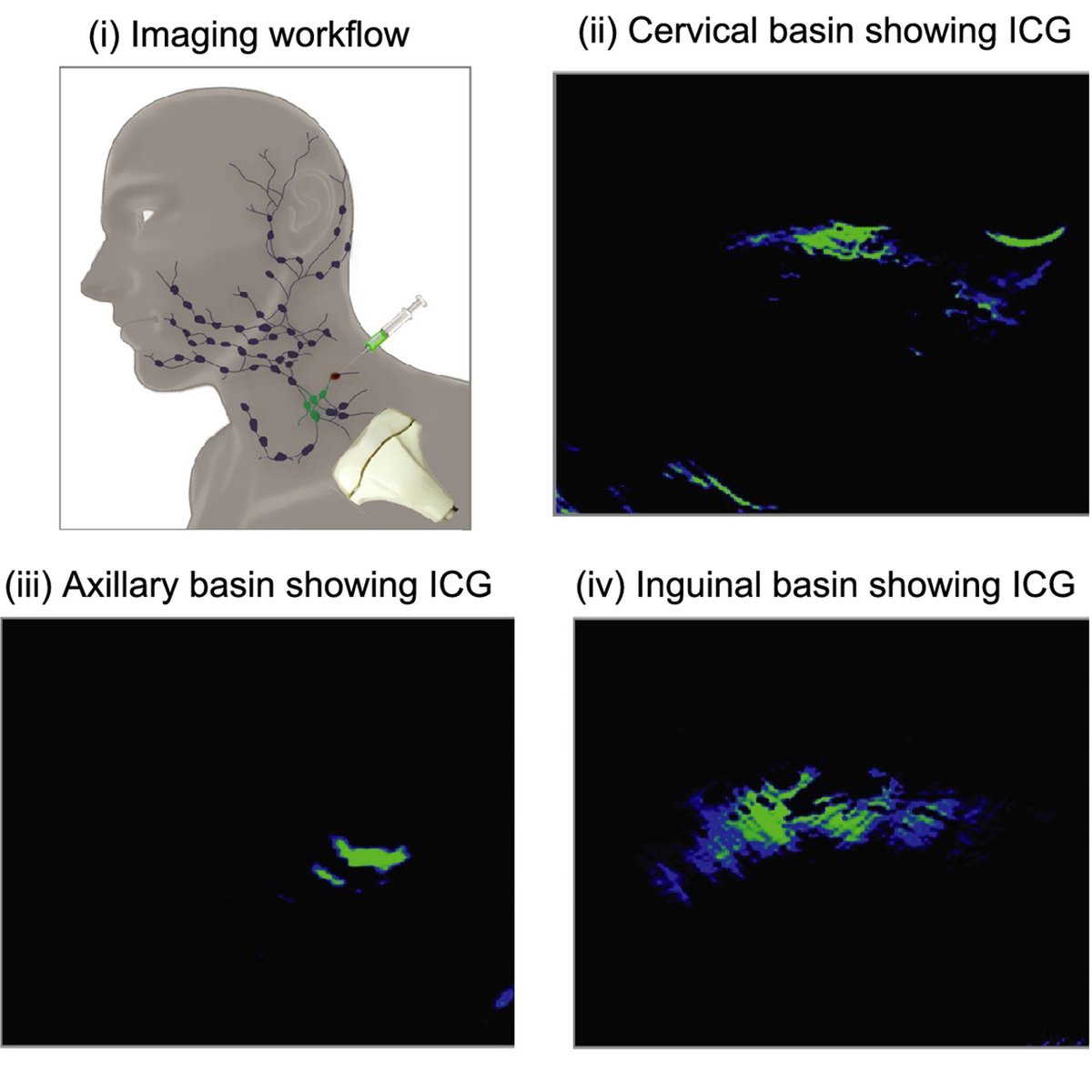 OpticaPubsGroup's tweet image. Via #OPG_BOEx: Clinical translation of photoacoustic imaging using exogenous molecular contrast agents [Invited] bit.ly/3JTzKaE #NeuroOncology #MolecularImaging @RiceUniversity