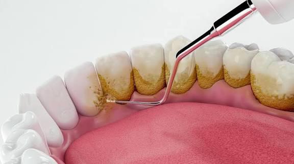 touchDentClinic's tweet photo. You brush every day, but you can't  clean your teeth as effective as professional teeth cleaning. Tender Touch is here for you, Contact us on. 0756-71-49-88 or 0782-85-41-22.  #health #teeth #foryoupage #Trending #men #everyone #mtnews #AITraining #YouTube #Uganda #vote4peace #me https://t.co/WSFDCaQ2Sp