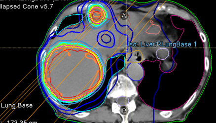 j_luh's tweet image. So I see a #lymphoma pt urgently with a large mass in the liver on 10/30/25. We submitted to @AnthemBCBS for authorization for palliative #XRT. They took their time and on 11/12/25, requested a 3D vs IMRT plan. We submitted it, knowing the extra dosimetry work would be done for…