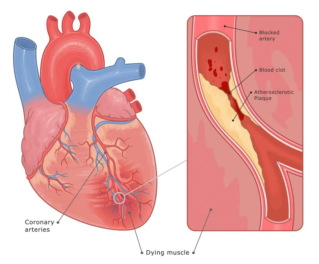 The FULL heart disease story - beyond cholesterol:

Why cholesterol alone fails:

◇ ~50% of heart attacks occur with “normal” LDL
◇ Very low cholesterol can ↑ mortality
◇ Cholesterol is only dangerous when arterial barriers break down

Artery damage begins with:

◇