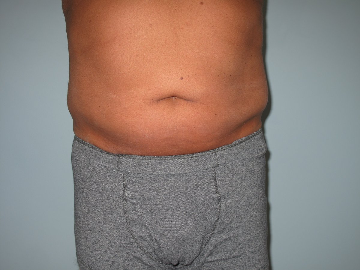 LaserVein's tweet image. 🔥 Ready to say goodbye to stubborn fat? See incredible before &amp;amp; after results and start your liposuction journey today! 😍

📞 Call 636-614-1665 to book your free consultation!

#Liposuction #LLVC #BodyTransformation #BeforeAndAfter