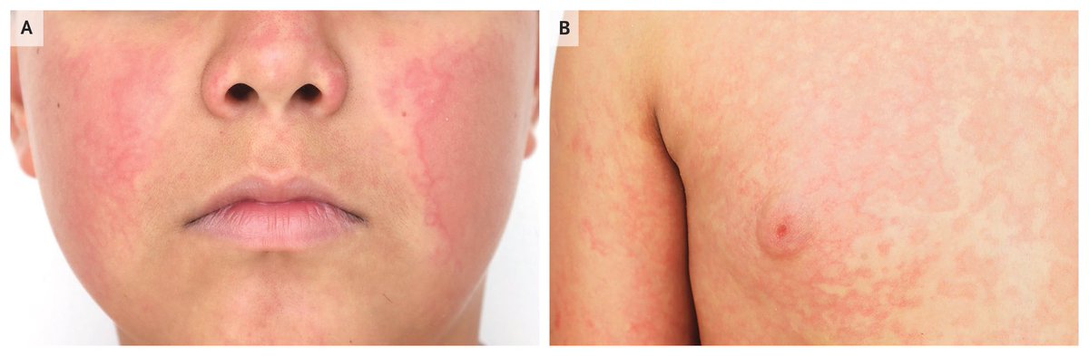 NEJM's tweet image. Images in Clinical Medicine: Erythema Infectiosum nej.md/47XEGDv

#Pediatrics #DermTwitter
