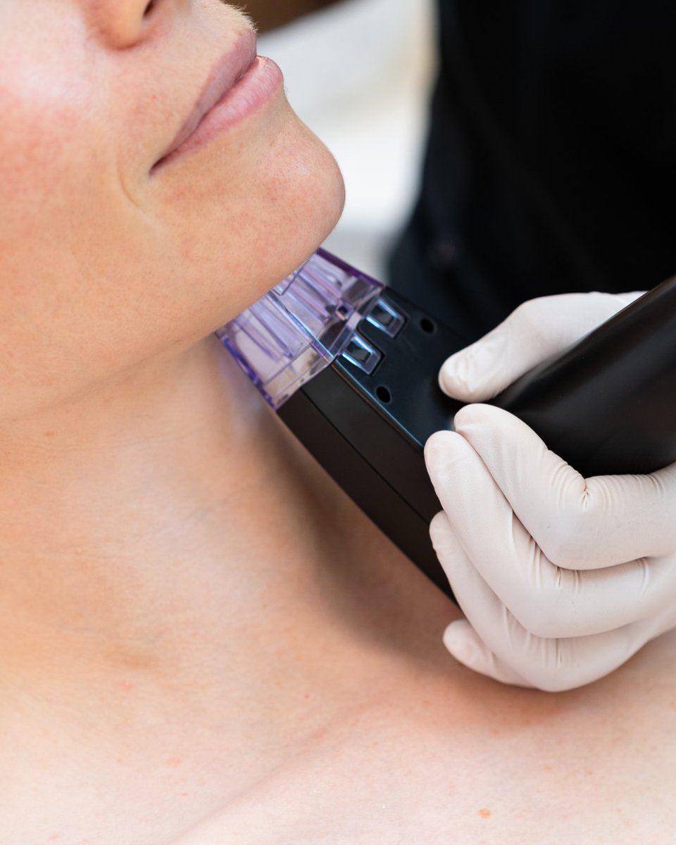 Morpheus8 is where deep collagen remodelling meets clinically precise skin tightening - refining texture, softening lines and lifting the contours for a more sculpted, youthful appearance.