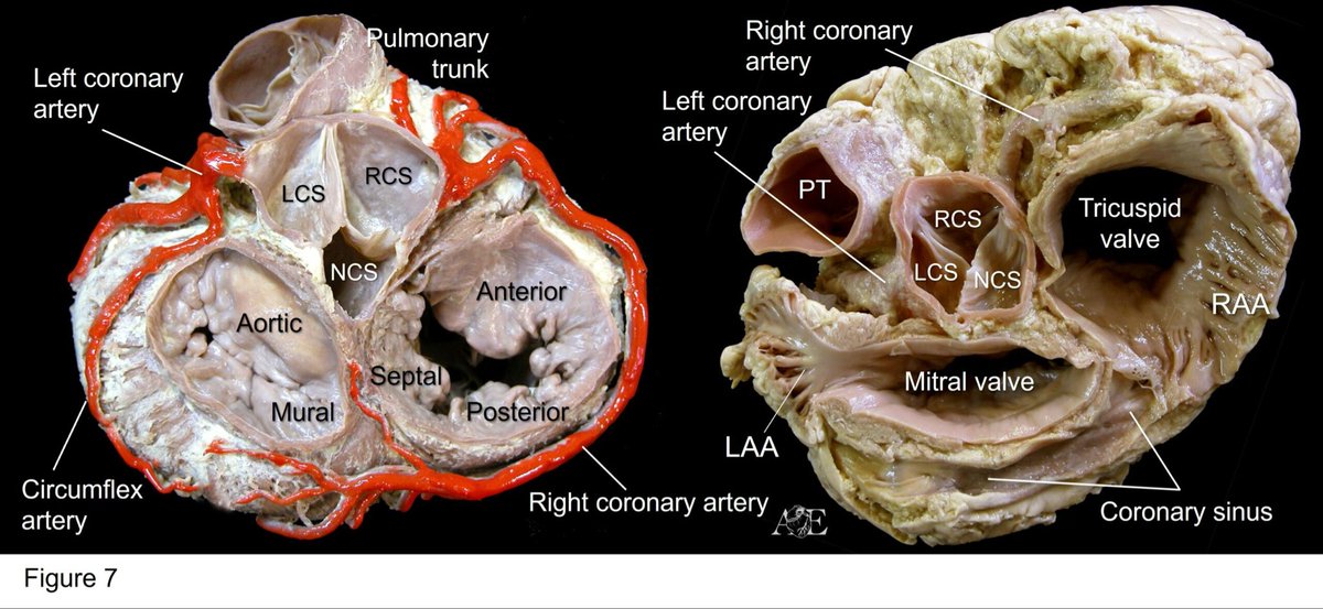 Atrial Anatomy and electrophsiology 
<a href="/TomasDatino/">@TomasDatino</a> <a href="/AdolfoFontenla/">Adolfo Fontenla</a> <a href="/jg_panizo/">Jorge G Panizo, MD</a> <a href="/davidgzcasal/">David González Casal</a> <a href="/DamianSanc1955/">Damian Sanchez Quintana</a> <a href="/NinaSoto1/">NinaSoto</a> 
<a href="/cardiac_anatomy/">Cardiac Anatomy</a> 
sciencedirect.com/science/chapte…