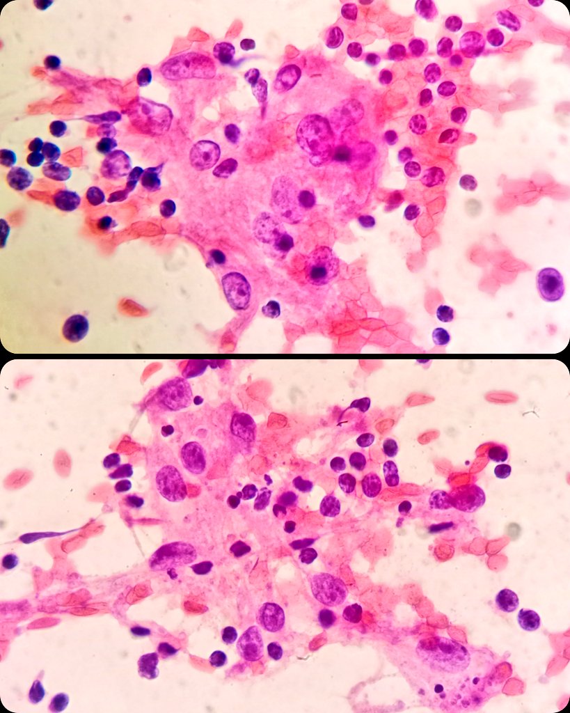 duckhuca's tweet image. 👦🏽 Young patient.
🐈 Animal contact.
📏 Submaxillary lymph node. 24mm.
💉 Ultrasound guided fine needle aspiration performed by Interventional Pathologist.
1️⃣ Pass.  25g.  No anesthesia.
🔬 Non-necrotizing lymphadenitis.
🐾 Cat-scratch disease.

#Cytology #CytoPath #Cytopathology