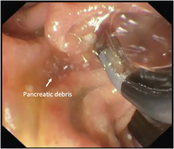 ASGEendoscopy's tweet image. VideoGIE Editor&apos;s Choice: &quot;Endoscopic retrograde pancreatography with pancreatic stenting as a therapeutic approach for pancreatic-portal vein fistula&quot; by Fabrizio Termite et al. View it here: hubs.ly/Q03Q_g780 #GITwitter #VideoGIE