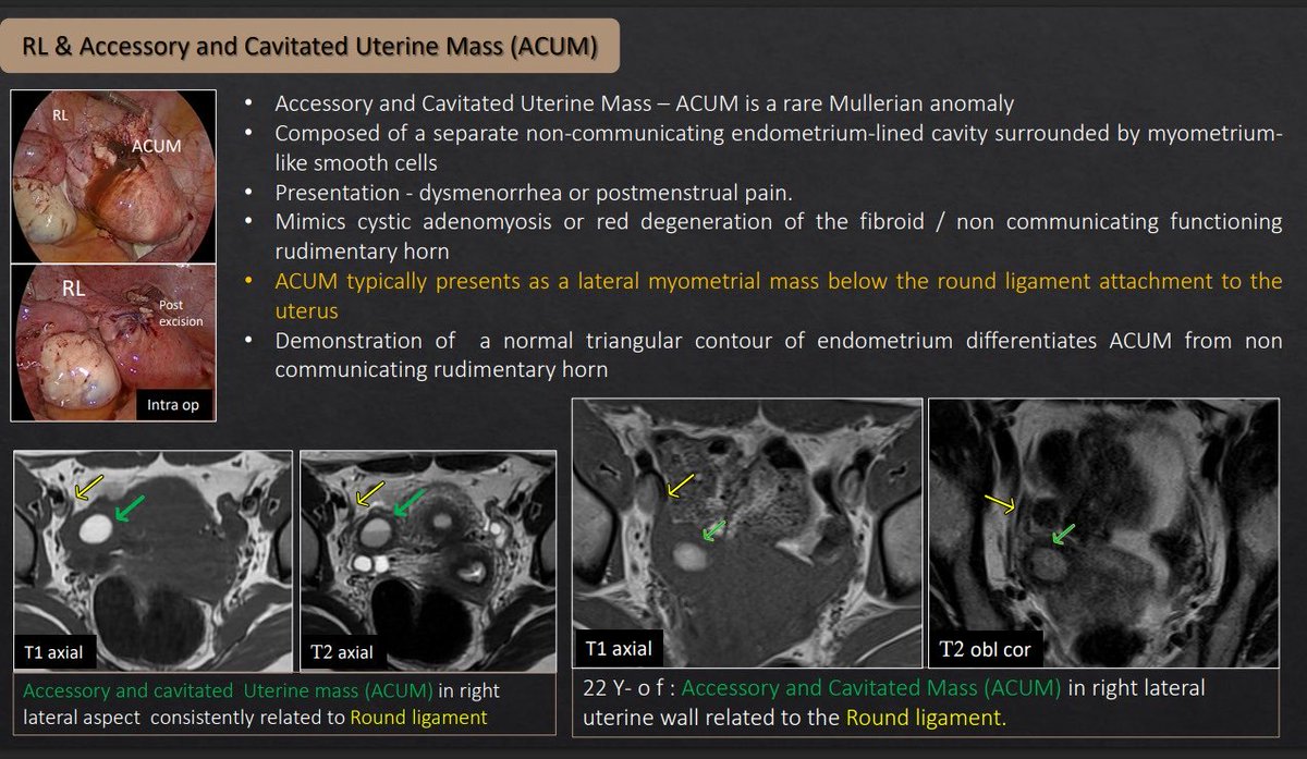 Let’s learn about Round Ligament <a href="/RSNA/">RSNA</a> #RSNA2025 #radiology #radres #radtwitter <a href="/EndometriosisUK/">Endometriosis UK</a> @endometriosis <a href="/Endofound/">Endometriosis Foundation of America (EndoFound)</a> #ectopic #pregnancy <a href="/SAR_RFS/">SAR Resident and Fellow Section</a> Thanks team <a href="/anurp269090/">anu rp</a> <a href="/ashenoybhangle/">Anu Shenoy Bhangle</a> <a href="/AnugayathriJ/">Anugayathri Jawahar</a>