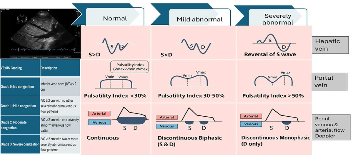 Ultrasound indicators of organ venous congestion: a narrative review

CCR Journal Watch 
criticalcarereviews.com/latest-evidenc…
