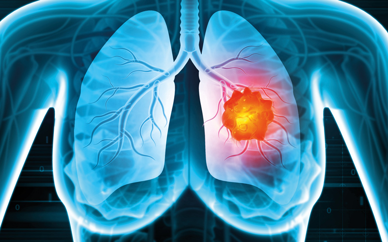 IBMScience's tweet image. People aged 75 to 80 can benefit from lung cancer screening as much as younger patients if they are fit for surgery.

Research suggests that extending screening up to age 80 could enable more curative treatments and improve survival.

Read in The Biomedical Scientist:…