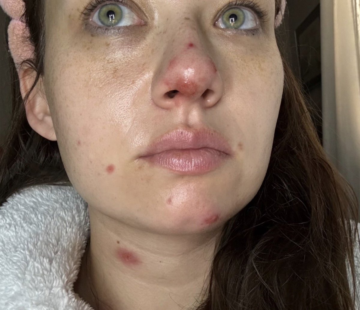 AshlynCooke_411's tweet image. Done being quiet. I have a story to tell, and these pictures are just the very tip of the iceberg. #vaccineinjured #Pfizer