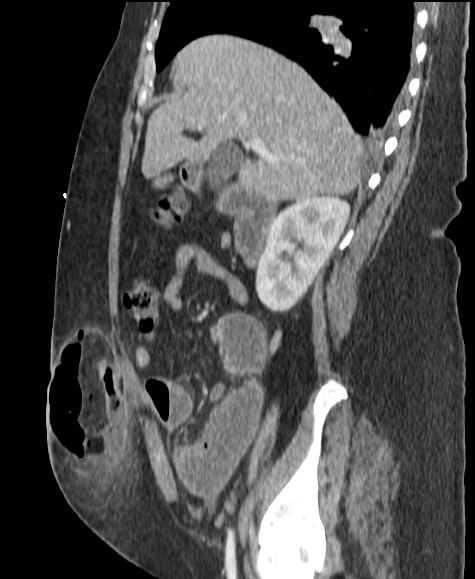 ItaniMalak's tweet photo. Case #31 in 2025  

Sagittal reformats on this abdominal CT showing 2  critical findings

answer in 24 hours

#MedEd #rad #radiology #abdrad #abdomen #imaging https://t.co/ClSH4JCUFk