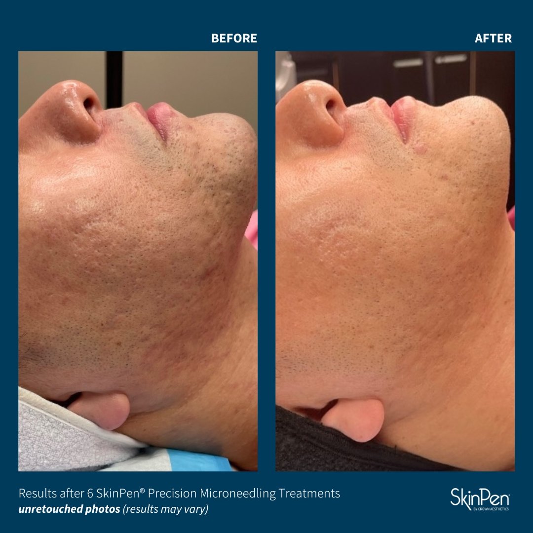 MWeightControls's tweet image. ✨ Black Friday Glow-Up Begins NOW ✨
These SkinPen results speak for themselves — smoother texture, refined pores, brighter tone, and a fresher, tighter complexion. Results shown are after 6 treatments ✨

For a limited time only, our SkinPen &amp;amp; SkinPen w/ PRP treatments are on…