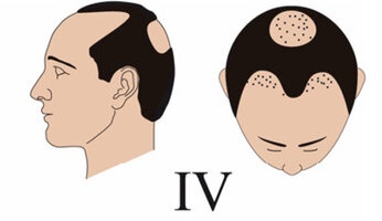 predozepam's tweet image. nossa mas eu fico possesso toda vez que um homem com ESTE PADRÃO de alopécia androgenética se acha no direito de dar em cima de mim