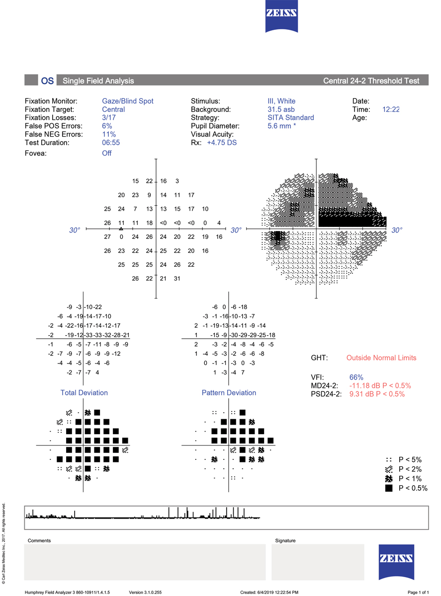 revoptom's tweet image. Standard 24-2 Visual Fields May Underestimate Central Progression, Study Finds

Incorporating 10-2 VF testing helps clinicians more accurately monitor glaucoma and guide treatment decisions.
reviewofoptometry.com/article/standa…
#glaucoma #optometry #eyecare
