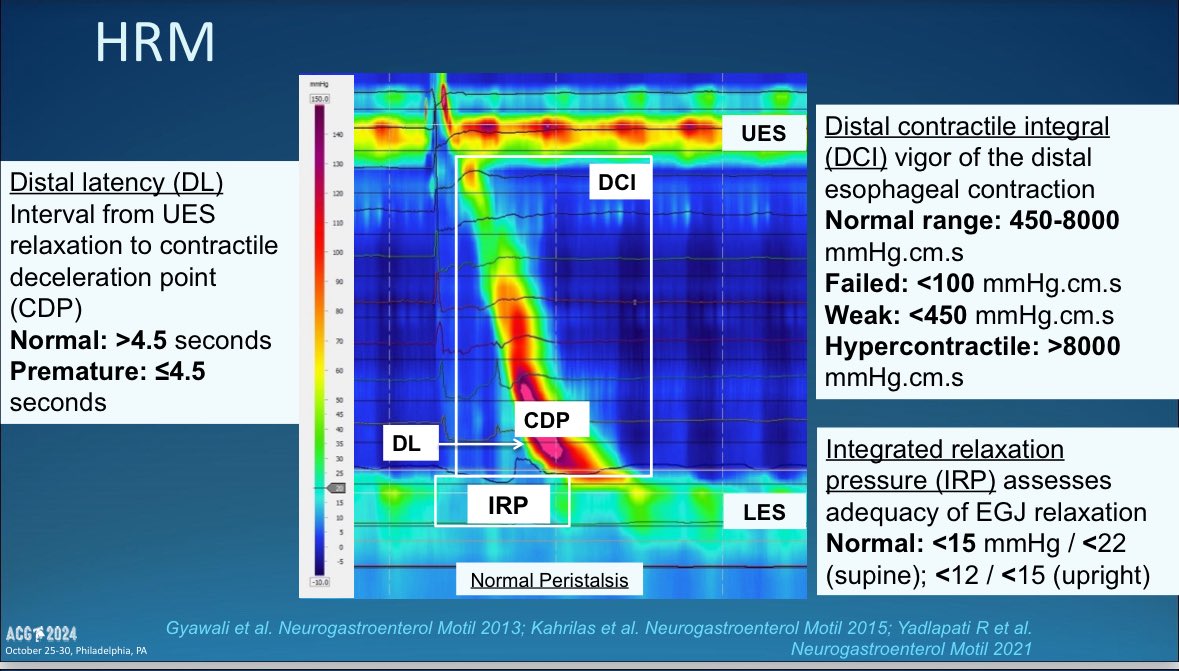 CarlKayMD's tweet image. Components of the High Resolution Esophageal Manometry 

▪️Distal Latency 
    ➡️ DL; normal &amp;gt;4.5 sec
▪️Distal Contractile Integral 
    ➡️ DCI; normal 450-8000 mmHgcms
▪️Integrated Relaxation Pressure 
    ➡️ IRP; normal &amp;lt;15 mmHg

#GITwitter