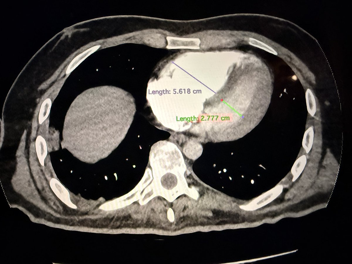 PertPoz's tweet photo. 25-year-old with #PE (SCAI B) Anticoagulation? Thrombolysis? Contraindicated after two SAH episodes and intracerebral bleeding. We proceeded with emergency #CAVT. High-stakes medicine at its finest —, data-driven, lifesaving. https://t.co/13C3yiLzCT