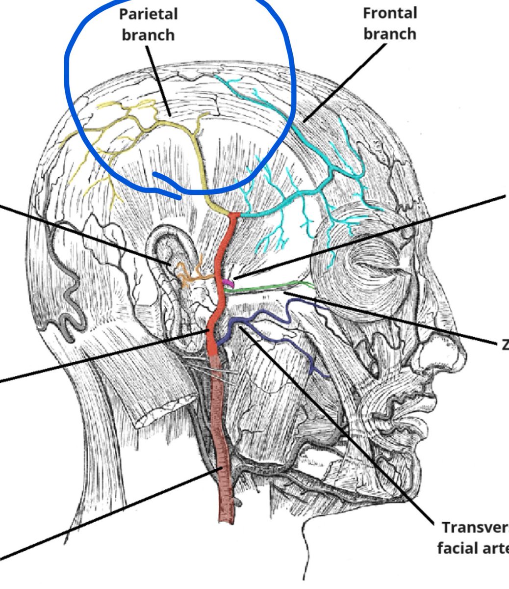 thecybersurg's tweet image. As I’m walking out the door of our surgery suite after a 24 case surgery day, one of our medical assistants flagged me down for a patient that was bleeding from her head. One of our docs did a biopsy on the scalp and hit a large parietal scalp artery. I walk in the room and…