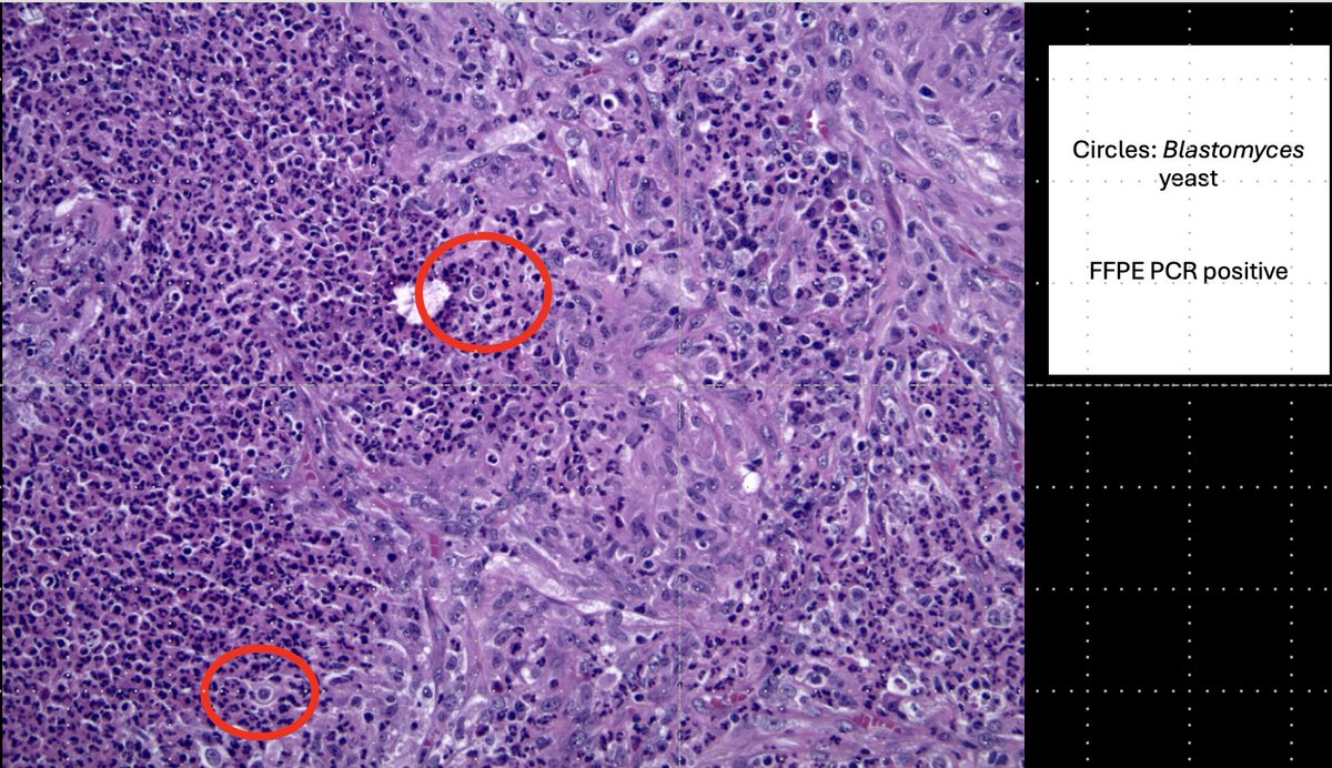 smlungpathguy's tweet image. Thread...
1. Every day, pathologists diagnose fungi in surgical pathology and cytology specimens from the lung. This thread = our experience (26 years)

Read article in @IJSPjournal 
journals.sagepub.com/doi/10.1177/10…

Pic: Blastomyces, case 17 of Table 1
#pulmpath #pathology #pathbugs