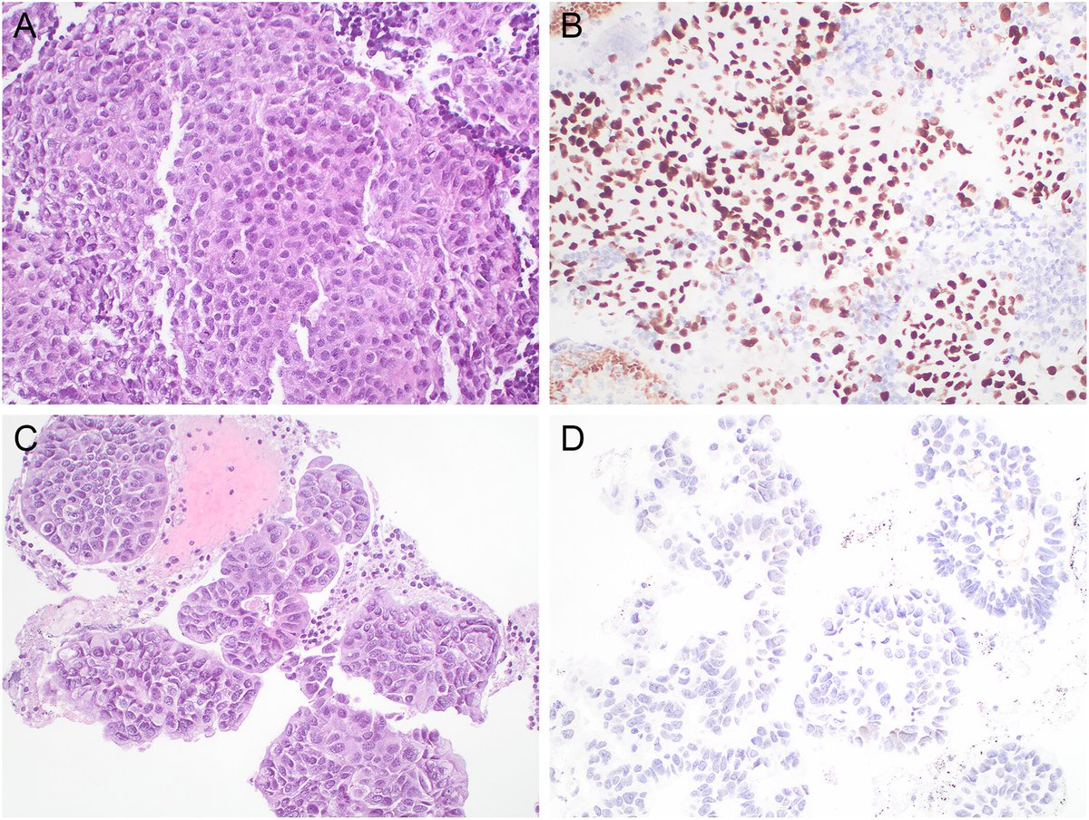 CancerCytopath's tweet image. 💡In this study, TRPS1 showed lower specificity as a breast immunomarker because of its expression in nonbreast tumors.

acsjournals.onlinelibrary.wiley.com/doi/full/10.10…

#CytoPath @DonthiDeepak @Jenny_QiongGan @QQingDing