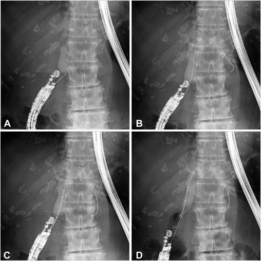 GIE_Journal's tweet image. In GIE’s Articles in Press: &quot;Fistula dilation-free EUS-guided choledochoduodenostomy using tubular dumbbell-shaped metal stent versus ERCP in first-line drainage for malignant distal biliary obstruction (with video)&quot; by Tadahisa Inoue et al. giejournal.org/article/S0016-…

#GITwitter